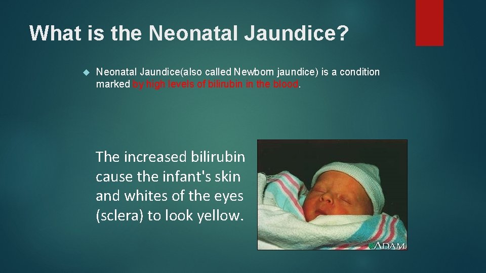 What is the Neonatal Jaundice? Neonatal Jaundice(also called Newborn jaundice) is a condition marked