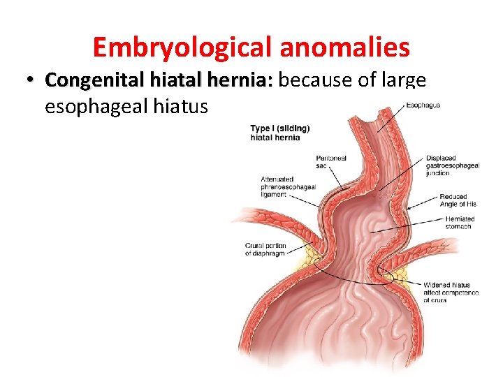 Embryological anomalies • Congenital hiatal hernia: because of large esophageal hiatus LUFUKUJA G. 51 Embryological anomalies • Congenital hiatal hernia: because of large esophageal hiatus LUFUKUJA G. 51