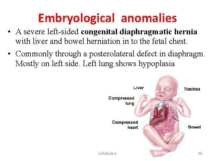 Embryological anomalies • A severe left-sided congenital diaphragmatic hernia with liver and bowel herniation Embryological anomalies • A severe left-sided congenital diaphragmatic hernia with liver and bowel herniation
