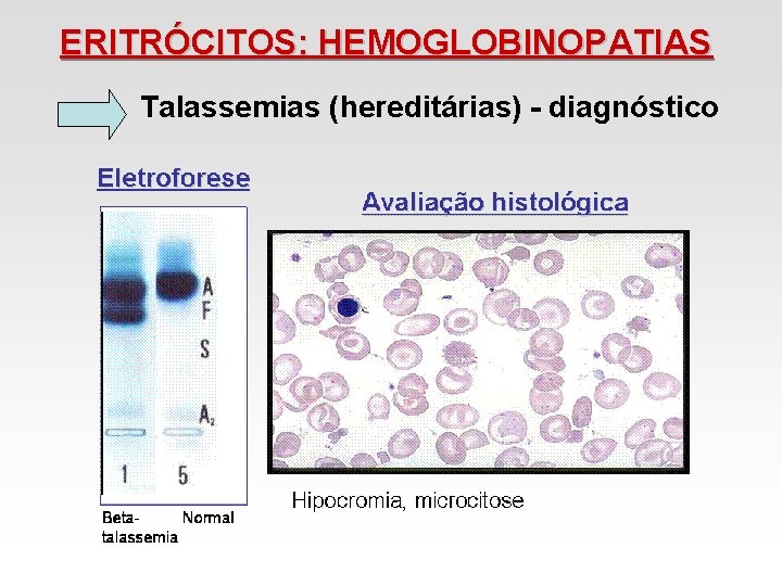 ERITRÓCITOS: HEMOGLOBINOPATIAS Talassemias (hereditárias) - diagnóstico ERITRÓCITOS: HEMOGLOBINOPATIAS Talassemias (hereditárias) - diagnóstico