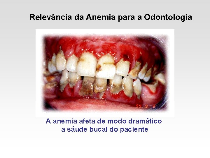 Relevância da Anemia para a Odontologia A anemia afeta de modo dramático a sáude Relevância da Anemia para a Odontologia A anemia afeta de modo dramático a sáude