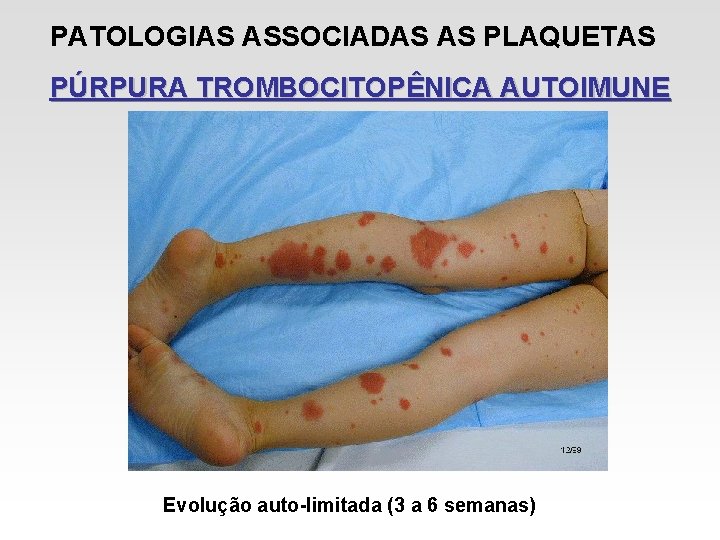 PATOLOGIAS ASSOCIADAS AS PLAQUETAS PÚRPURA TROMBOCITOPÊNICA AUTOIMUNE Evolução auto-limitada (3 a 6 semanas) PATOLOGIAS ASSOCIADAS AS PLAQUETAS PÚRPURA TROMBOCITOPÊNICA AUTOIMUNE Evolução auto-limitada (3 a 6 semanas)