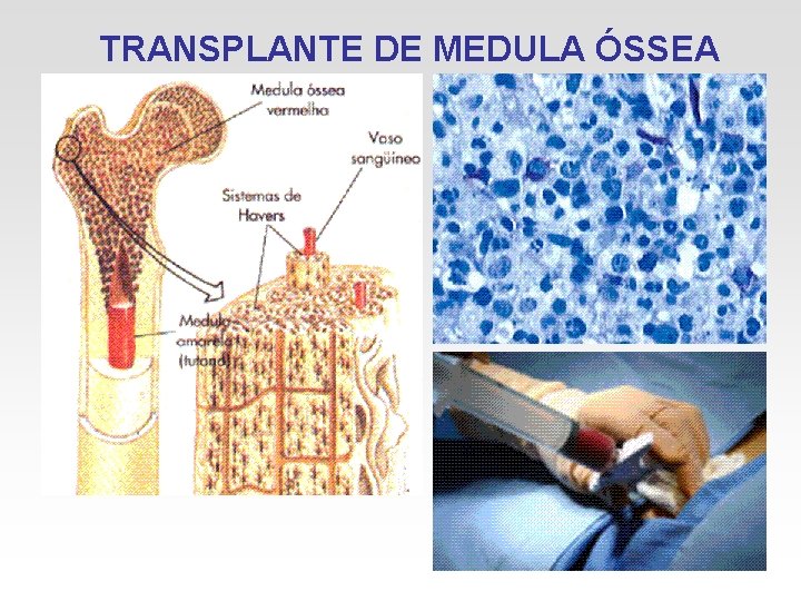TRANSPLANTE DE MEDULA ÓSSEA TRANSPLANTE DE MEDULA ÓSSEA