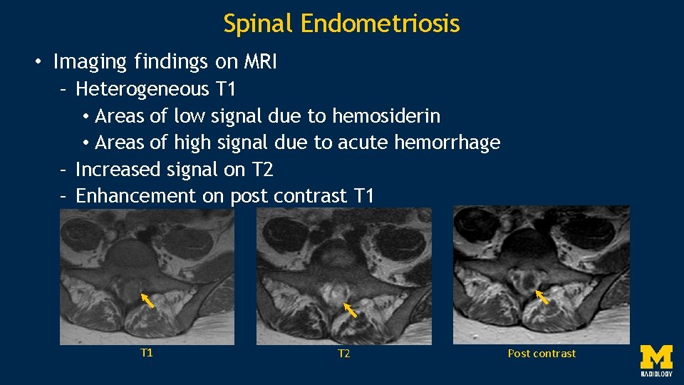 Spinal Endometriosis • Imaging findings on MRI – Heterogeneous T 1 • Areas of