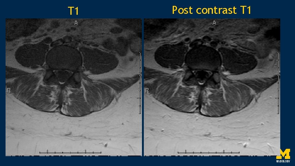 T 1 Post contrast T 1 