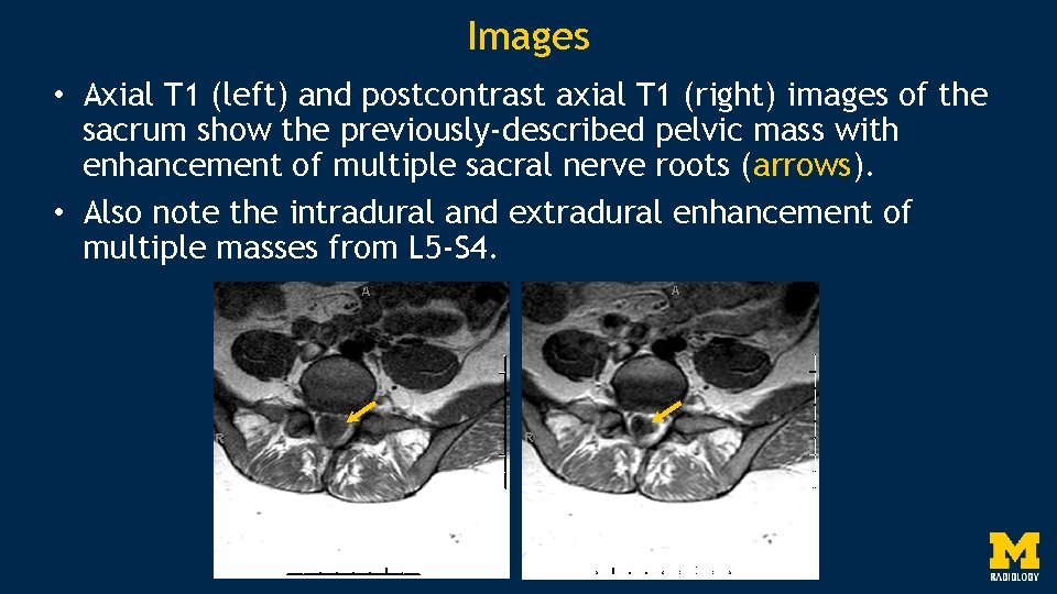 Images • Axial T 1 (left) and postcontrast axial T 1 (right) images of