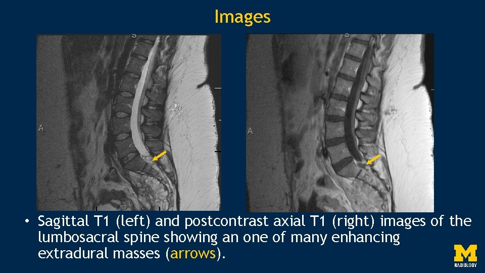 Images • Sagittal T 1 (left) and postcontrast axial T 1 (right) images of