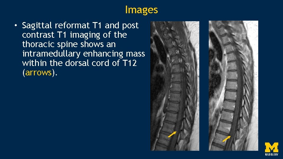 Images • Sagittal reformat T 1 and post contrast T 1 imaging of the