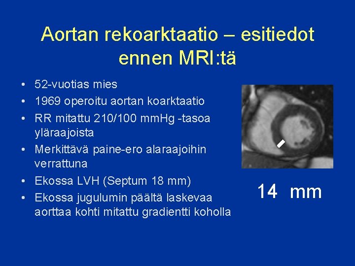 Aortan rekoarktaatio – esitiedot ennen MRI: tä • 52 -vuotias mies • 1969 operoitu