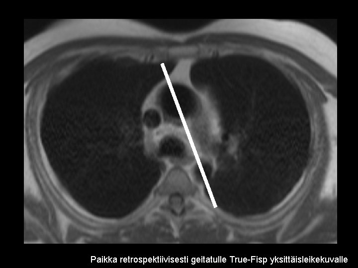 Paikka retrospektiivisesti geitatulle True-Fisp yksittäisleikekuvalle 