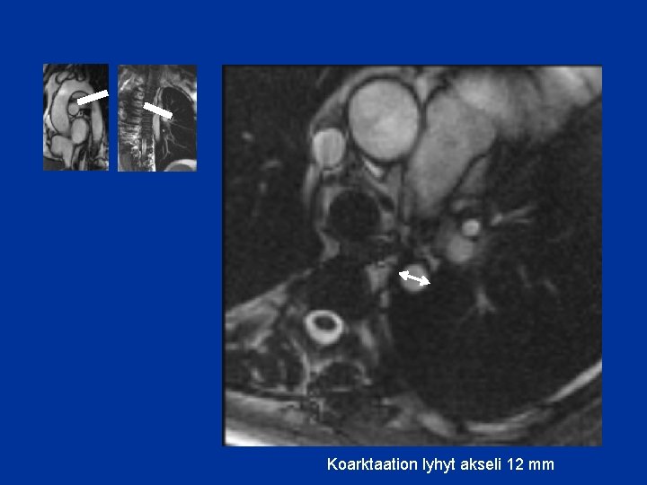 Koarktaation lyhyt akseli 12 mm 