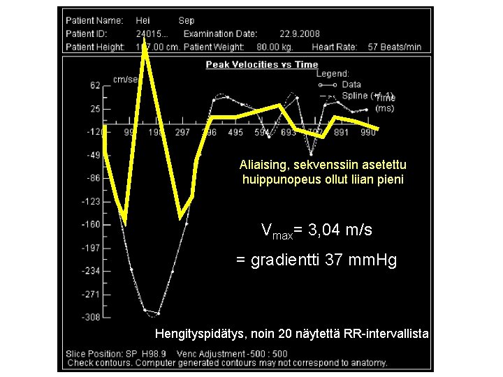 Aliaising, sekvenssiin asetettu huippunopeus ollut liian pieni Vmax= 3, 04 m/s = gradientti 37