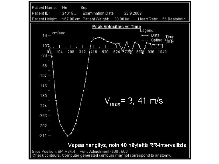 Vmax= 3, 41 m/s Vapaa hengitys, noin 40 näytettä RR-intervallista 