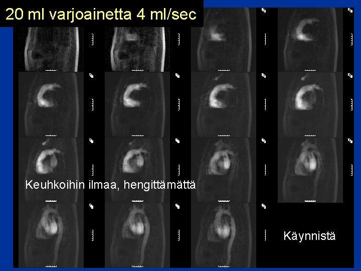 20 ml varjoainetta 4 ml/sec Keuhkoihin ilmaa, hengittämättä Käynnistä 