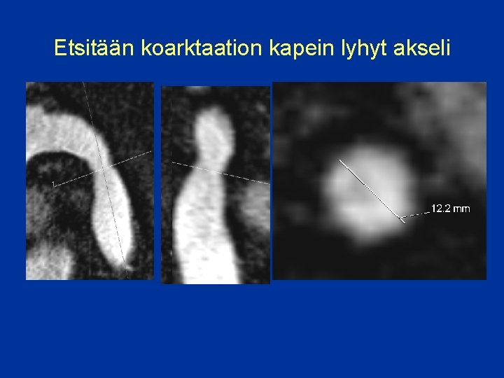 Etsitään koarktaation kapein lyhyt akseli 