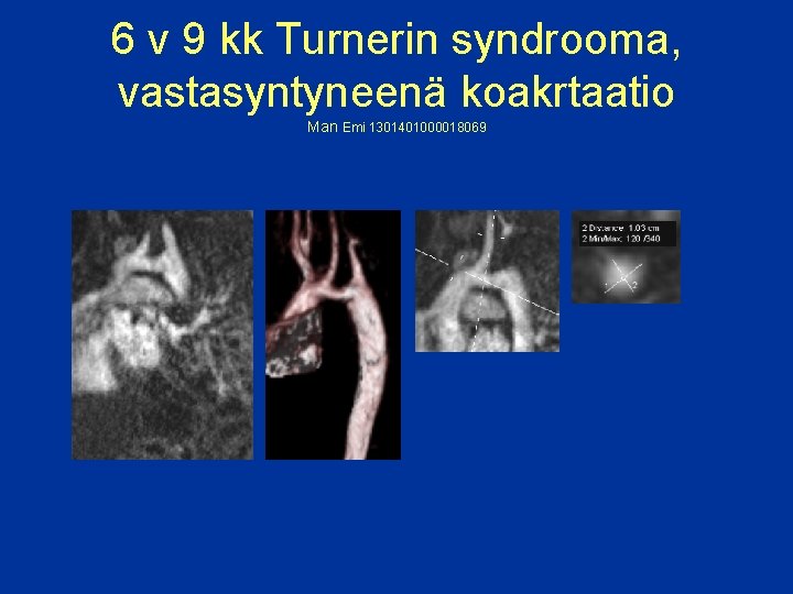 6 v 9 kk Turnerin syndrooma, vastasyntyneenä koakrtaatio Man Emi 1301401000018069 