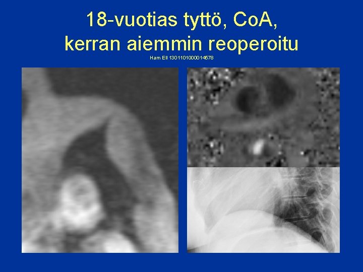 18 -vuotias tyttö, Co. A, kerran aiemmin reoperoitu Ham Ell 1301101000014578 