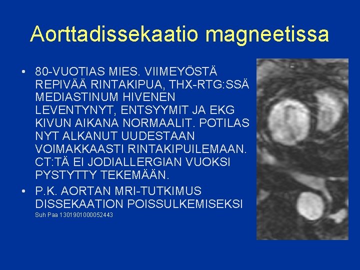 Aorttadissekaatio magneetissa • 80 -VUOTIAS MIES. VIIMEYÖSTÄ REPIVÄÄ RINTAKIPUA, THX-RTG: SSÄ MEDIASTINUM HIVENEN LEVENTYNYT,