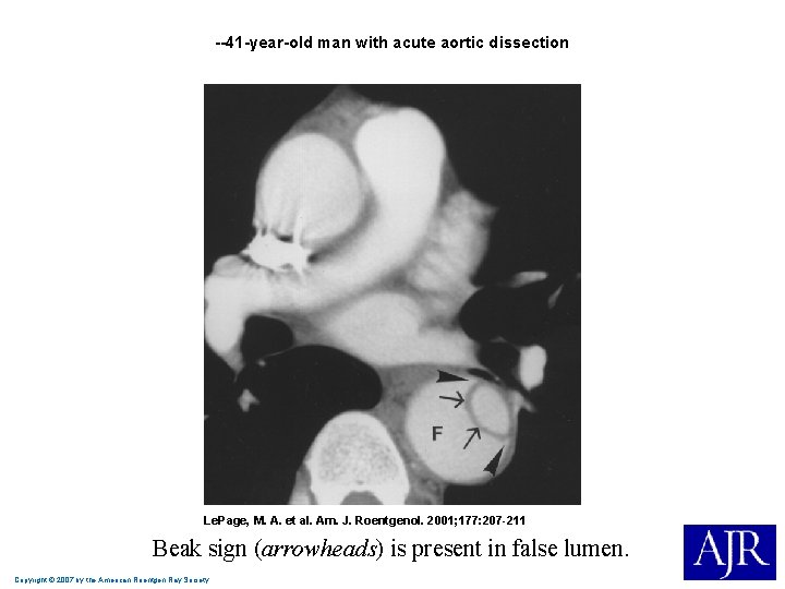 --41 -year-old man with acute aortic dissection Le. Page, M. A. et al. Am.