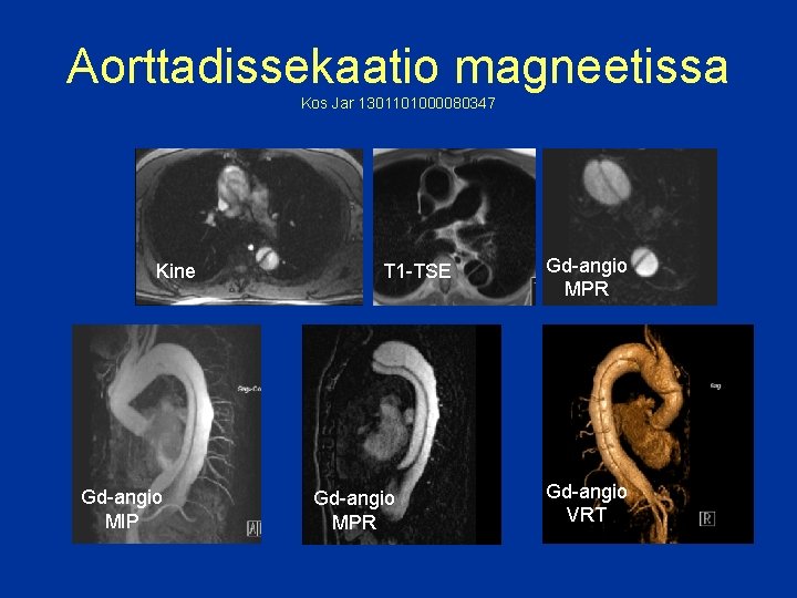 Aorttadissekaatio magneetissa Kos Jar 1301101000080347 Kine Gd-angio MIP T 1 -TSE Gd-angio MPR Gd-angio