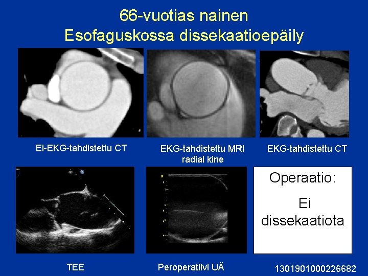 66 -vuotias nainen Esofaguskossa dissekaatioepäily Ei-EKG-tahdistettu CT EKG-tahdistettu MRI radial kine EKG-tahdistettu CT Operaatio: