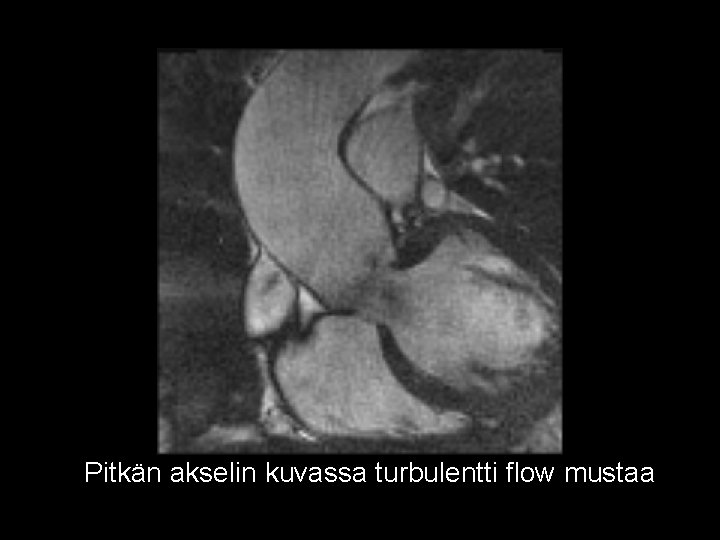 Pitkän akselin kuvassa turbulentti flow mustaa 