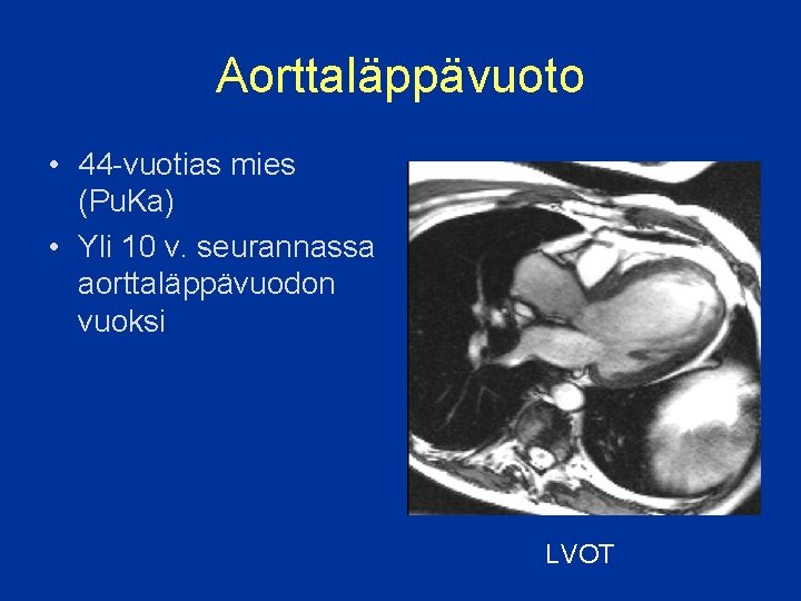 Aorttaläppävuoto • 44 -vuotias mies (Pu. Ka) • Yli 10 v. seurannassa aorttaläppävuodon vuoksi