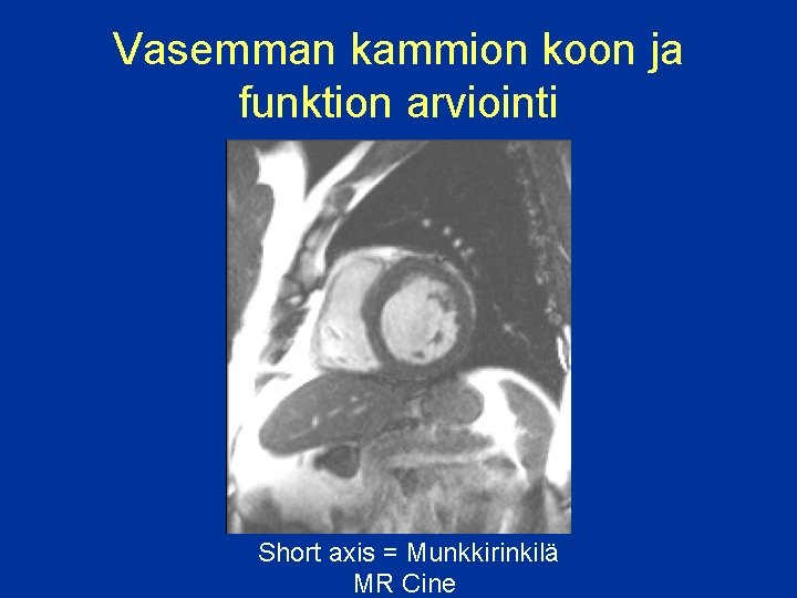 Vasemman kammion koon ja funktion arviointi Short axis = Munkkirinkilä MR Cine 