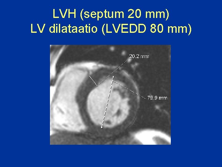 LVH (septum 20 mm) LV dilataatio (LVEDD 80 mm) 