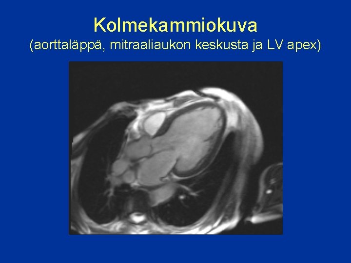 Kolmekammiokuva (aorttaläppä, mitraaliaukon keskusta ja LV apex) 