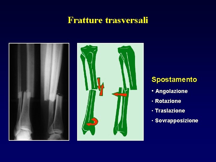 Fratture trasversali Spostamento • Angolazione • Rotazione • Traslazione • Sovrapposizione 