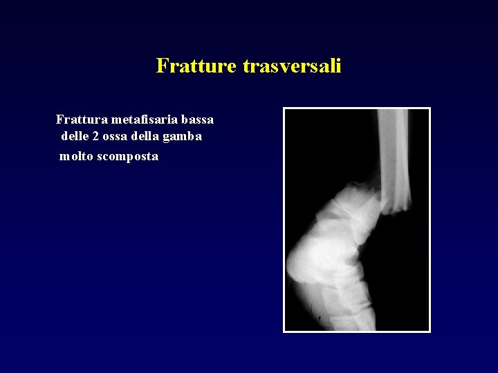 Fratture trasversali Frattura metafisaria bassa delle 2 ossa della gamba molto scomposta 