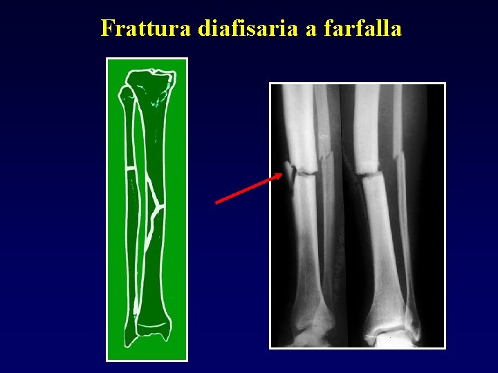 Frattura diafisaria a farfalla 