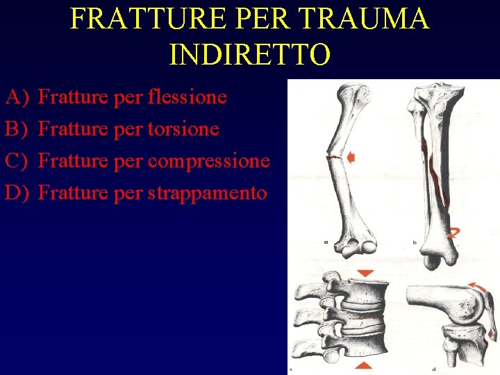 FRATTURE PER TRAUMA INDIRETTO A) B) C) D) Fratture per flessione Fratture per torsione