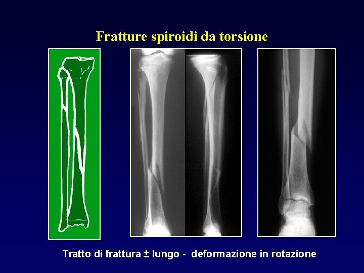 Fratture spiroidi da torsione Tratto di frattura ± lungo - deformazione in rotazione 