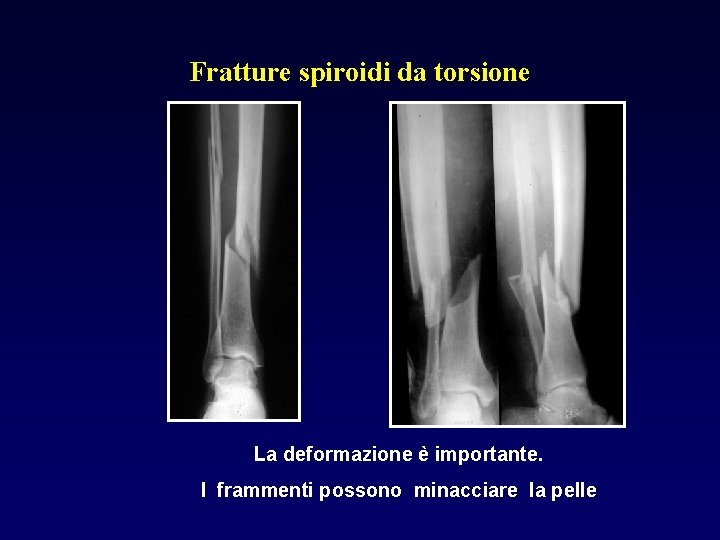 Fratture spiroidi da torsione La deformazione è importante. I frammenti possono minacciare la pelle