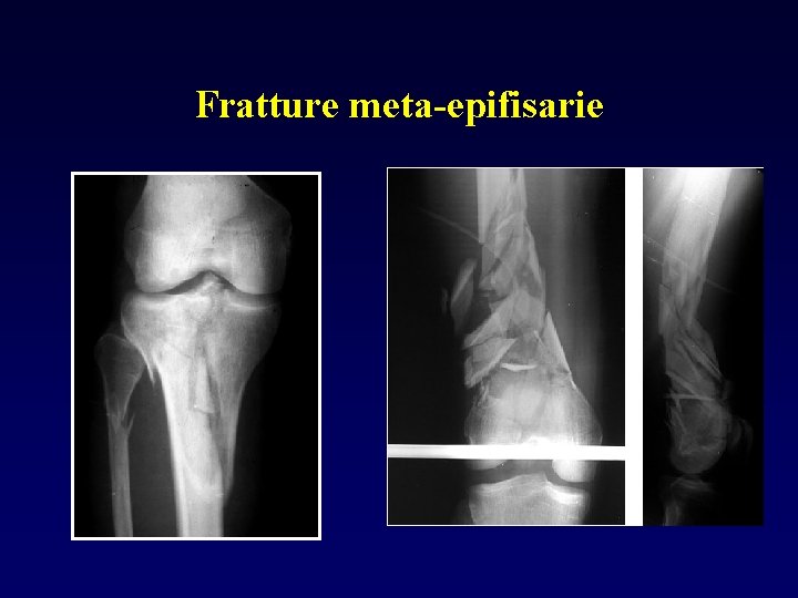 Fratture meta-epifisarie 