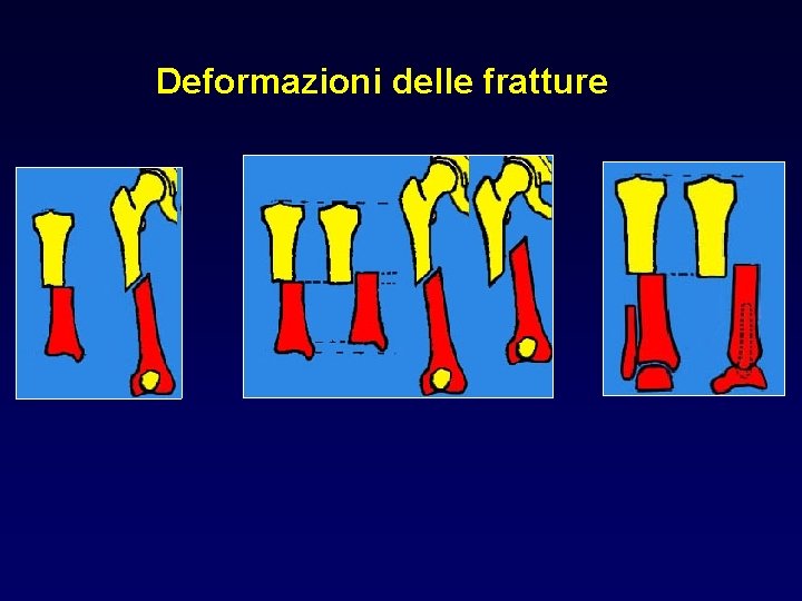 Deformazioni delle fratture 