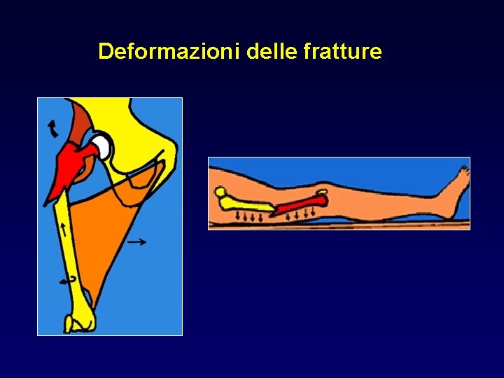 Deformazioni delle fratture 