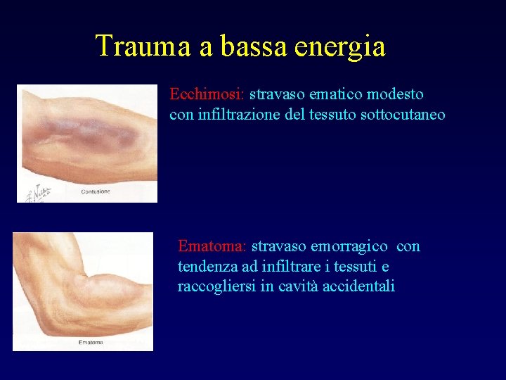 Trauma a bassa energia Ecchimosi: stravaso ematico modesto con infiltrazione del tessuto sottocutaneo Ematoma: