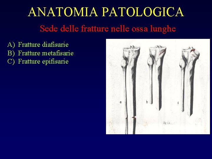 ANATOMIA PATOLOGICA Sede delle fratture nelle ossa lunghe A) Fratture diafisarie B) Fratture metafisarie