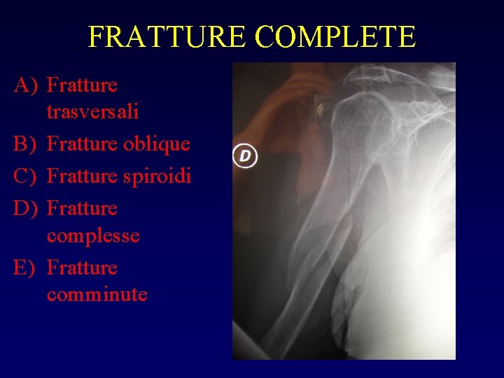 FRATTURE COMPLETE A) Fratture trasversali B) Fratture oblique C) Fratture spiroidi D) Fratture complesse