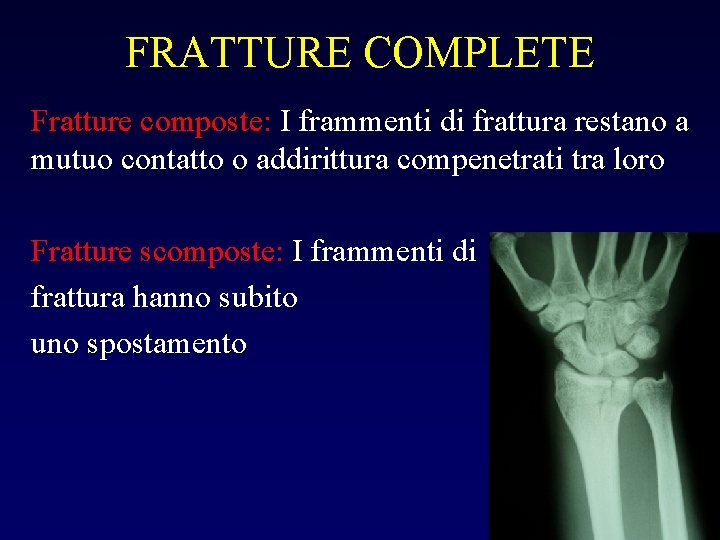 FRATTURE COMPLETE Fratture composte: I frammenti di frattura restano a mutuo contatto o addirittura