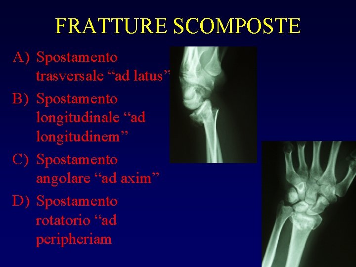 FRATTURE SCOMPOSTE A) Spostamento trasversale “ad latus” B) Spostamento longitudinale “ad longitudinem” C) Spostamento