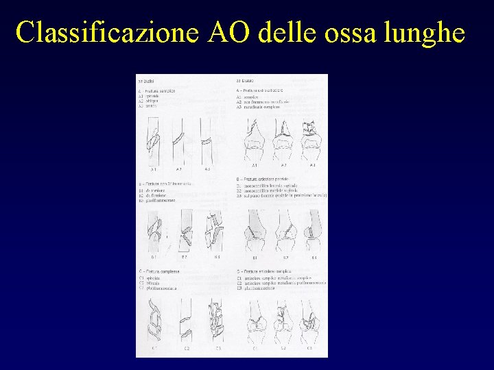 Classificazione AO delle ossa lunghe 