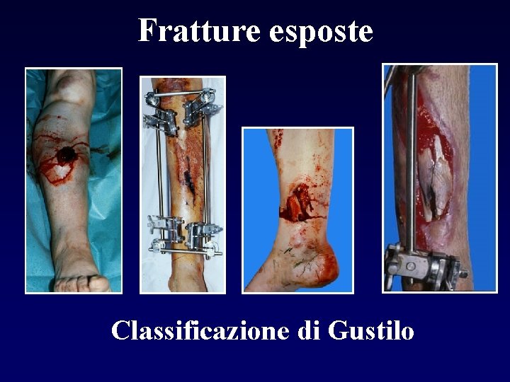 Fratture esposte Classificazione di Gustilo 