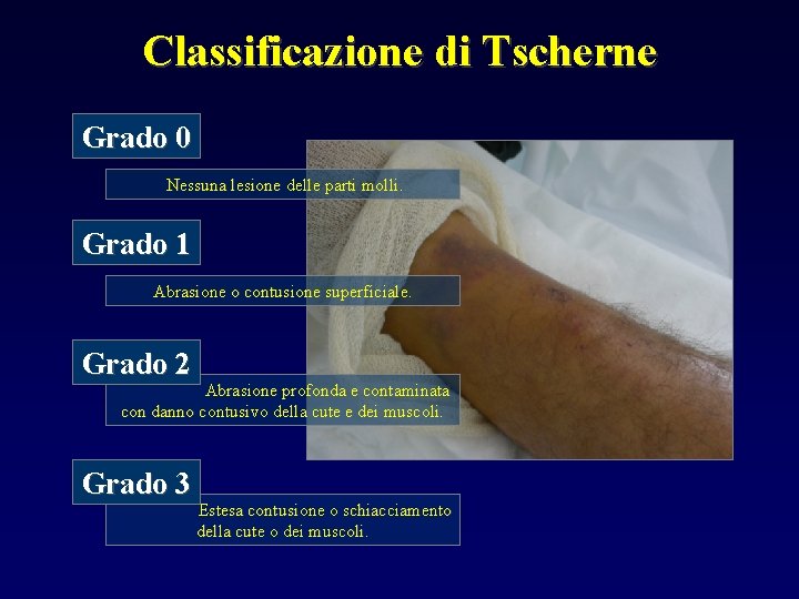 Classificazione di Tscherne Grado 0 Nessuna lesione delle parti molli. Grado 1 Abrasione o