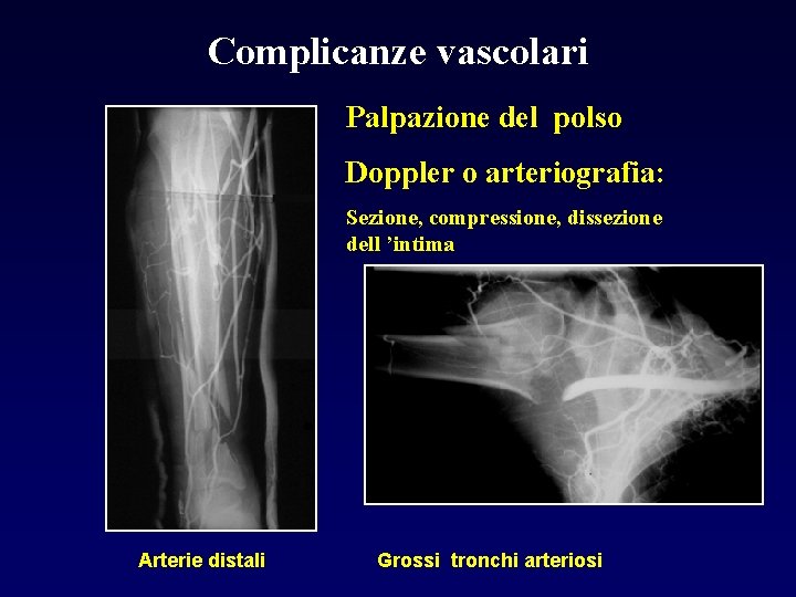 Complicanze vascolari Palpazione del polso Doppler o arteriografia: Sezione, compressione, dissezione dell ’intima Arterie