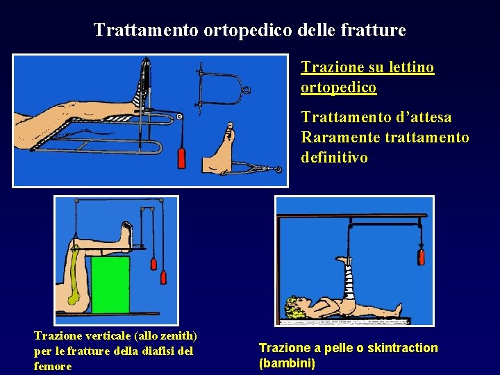 Trattamento ortopedico delle fratture Trazione su lettino ortopedico Trattamento d’attesa Raramente trattamento definitivo Trazione