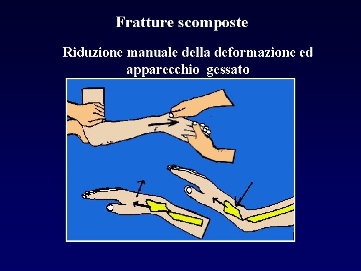 Fratture scomposte Riduzione manuale della deformazione ed apparecchio gessato 